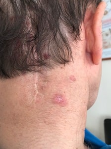 Рецидив базалиомы: причины, симптомы, диагностика и лечение Рецидив базалиомы: причины, симптомы, диагностика и лечение