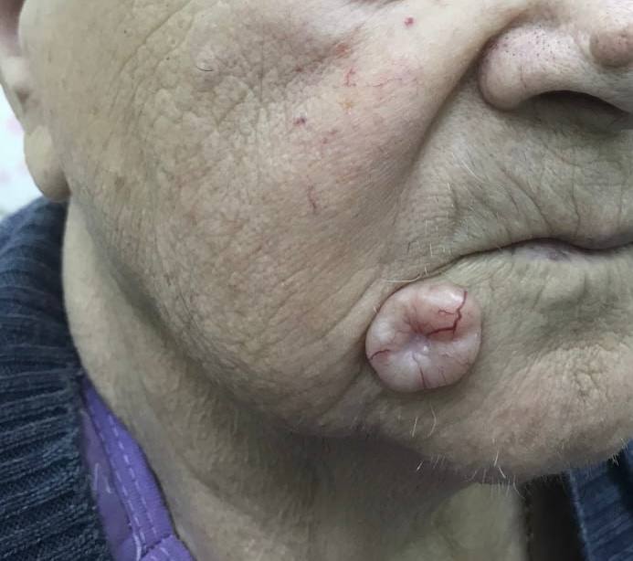 Базалиома как вид рака Базалиома как вид рака
