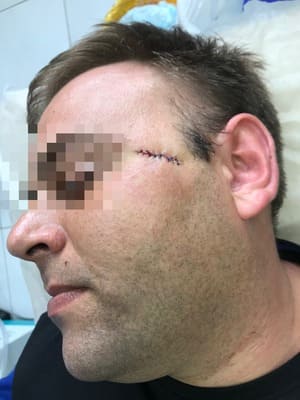 Хирургическое удаление базалиомы: виды операций, плюсы и минусы Хирургическое удаление базалиомы: виды операций, плюсы и минусы
