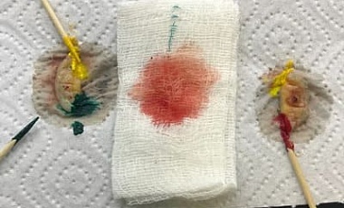���������������� �������� �� ���� (Mohs surgery)